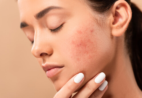 young woman with closed eyes touching face with acne isolated on