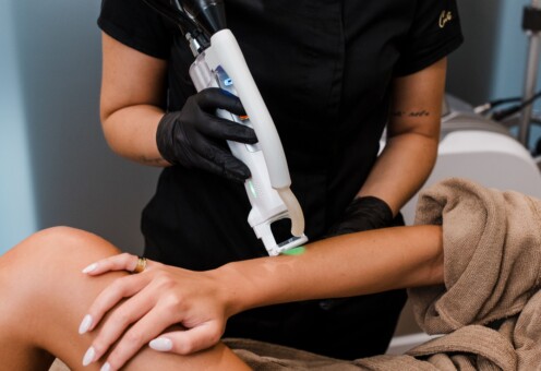 Laserska epilacija 15