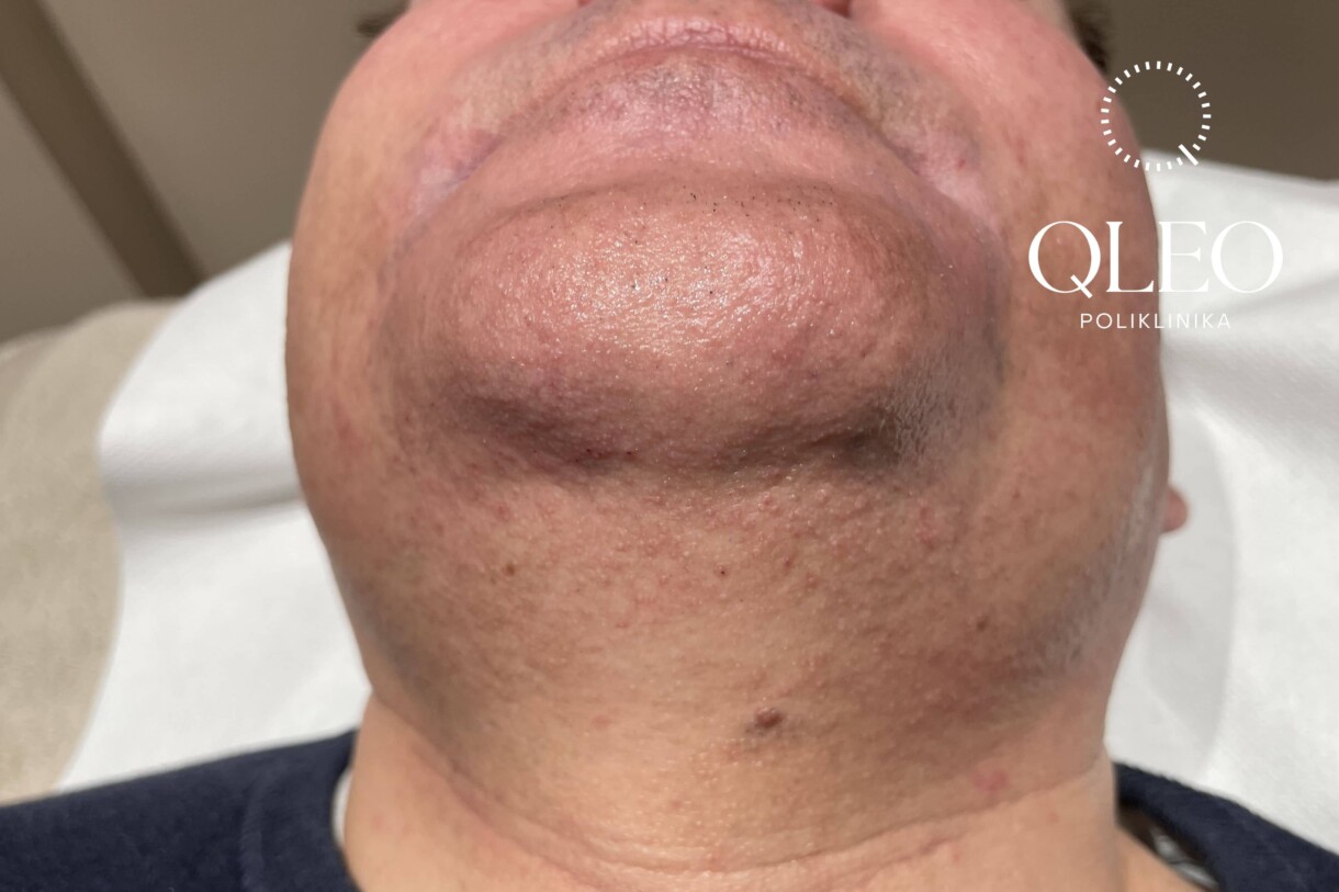 LASERSKA EPILACIJA MUŠKARCI BRADA POSLIJE