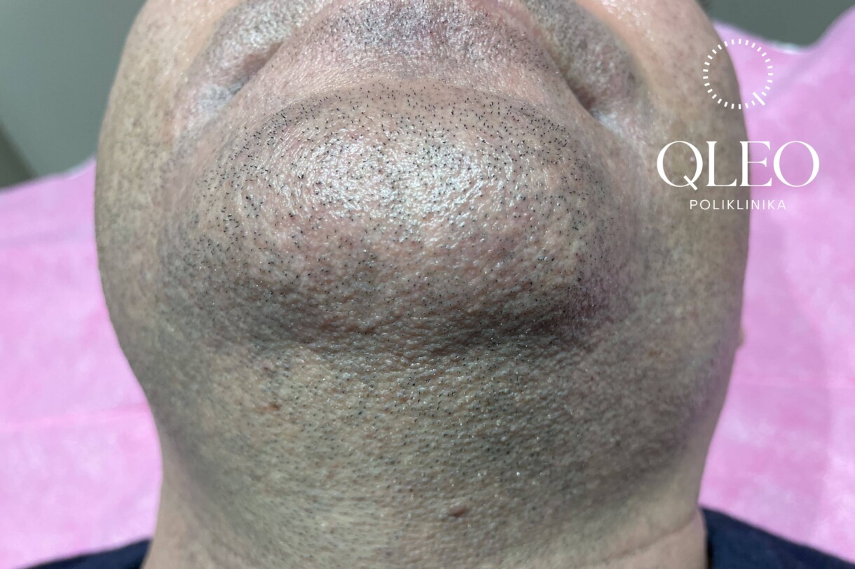 LASERSKA EPILACIJA MUŠKARCI BRADA PRIJE