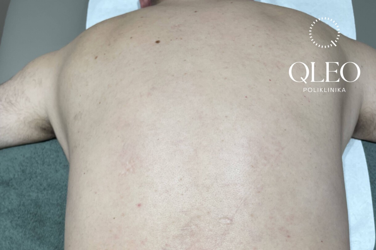 LASERSKA EPILACIJA MUŠKARCI LEĐA POSLIJE