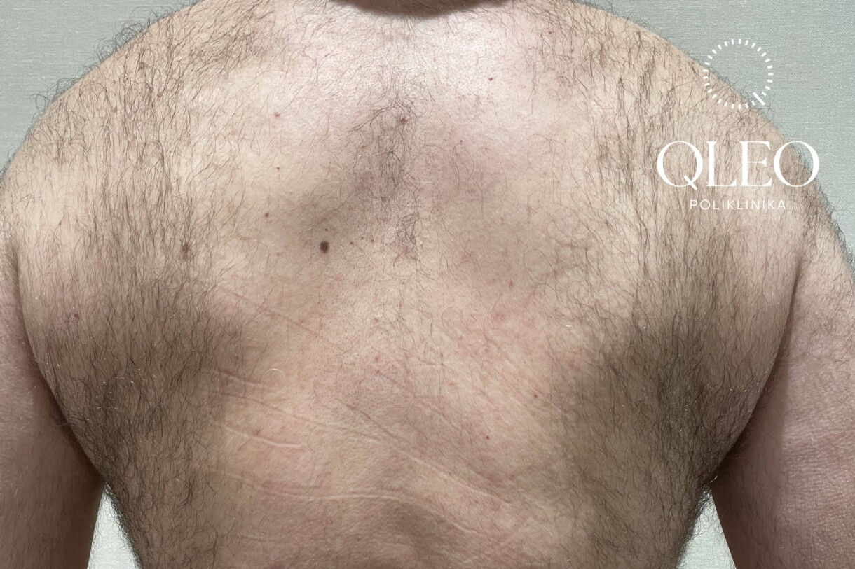 LASERSKA EPILACIJA MUŠKARCI LEĐA PRIJE