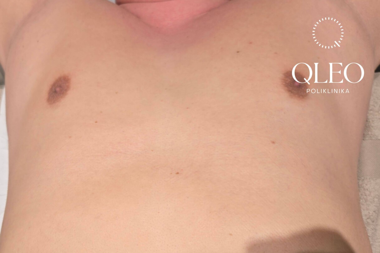 LASERSKA EPILACIJA MUŠKARCI PRSA POSLIJE