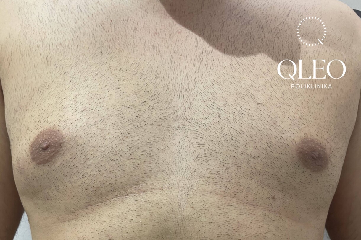 LASERSKA EPILACIJA MUŠKARCI PRSA PRIJE