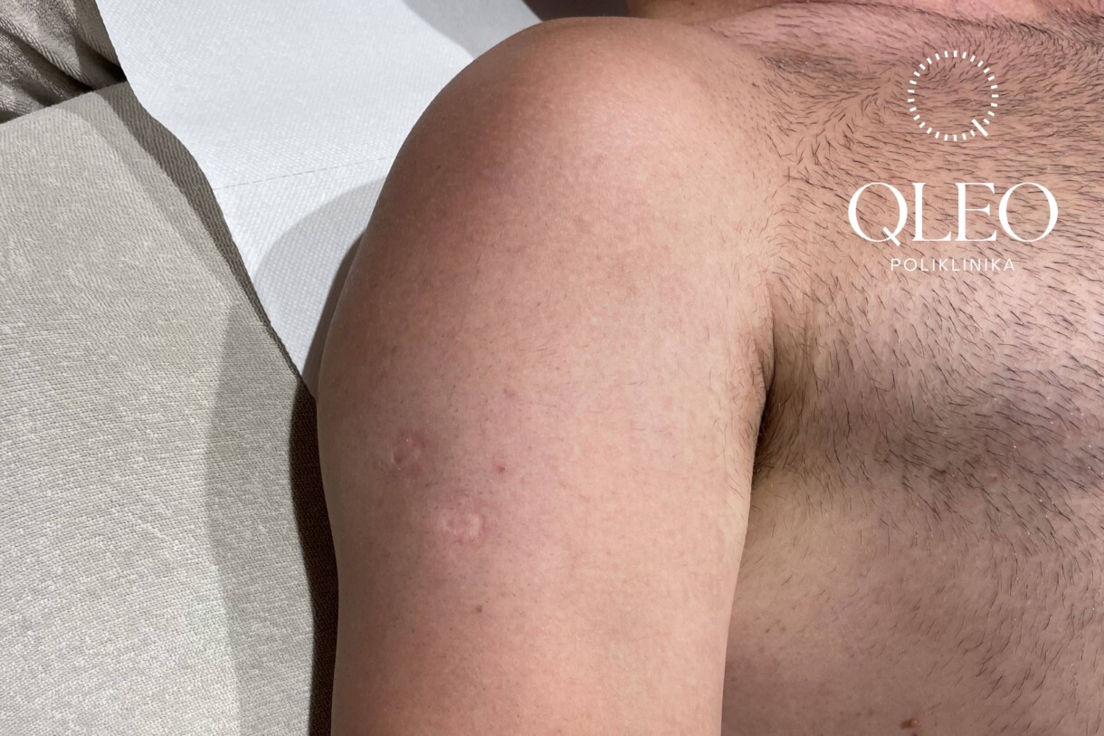 LASERSKA EPILACIJA MUŠKARCI RAMENA POSLIJE