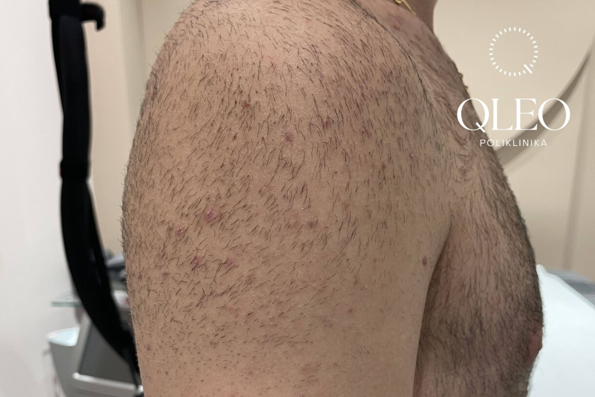 LASERSKA EPILACIJA MUŠKARCI RAMENA PRIJE