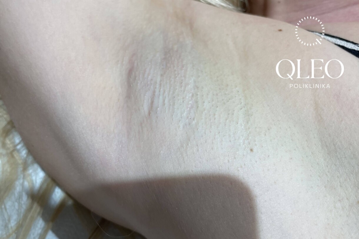 LASERSKA EPILACIJA ŽENE PAZUH POSLIJE