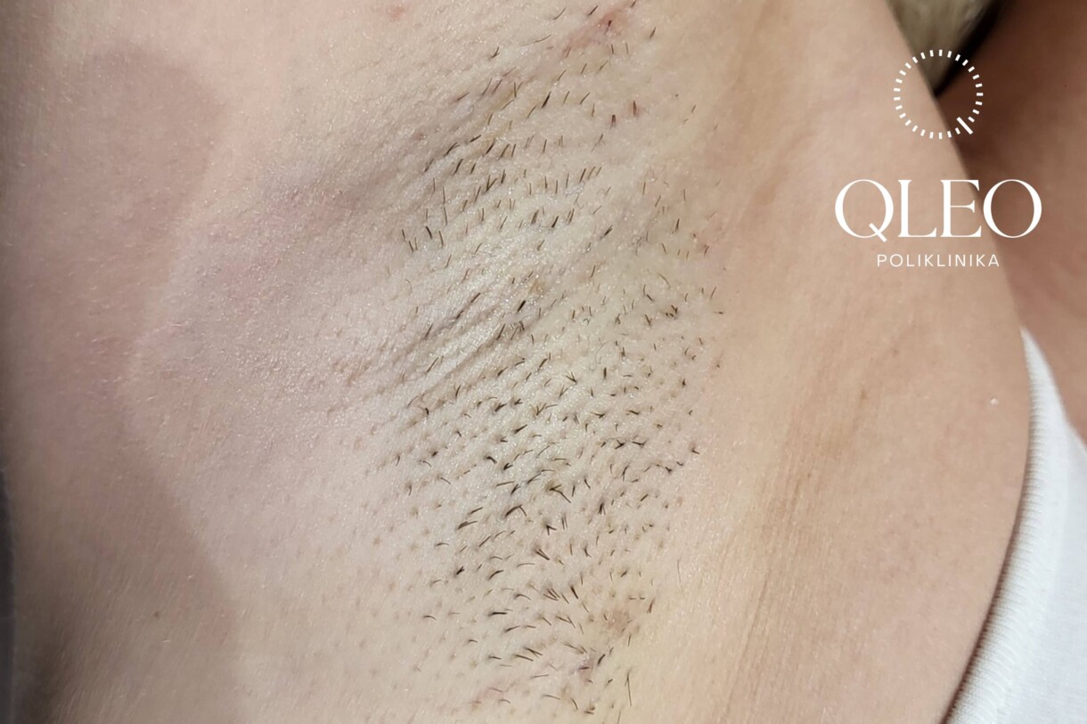 LASERSKA EPILACIJA ŽENE PAZUH PRIJE