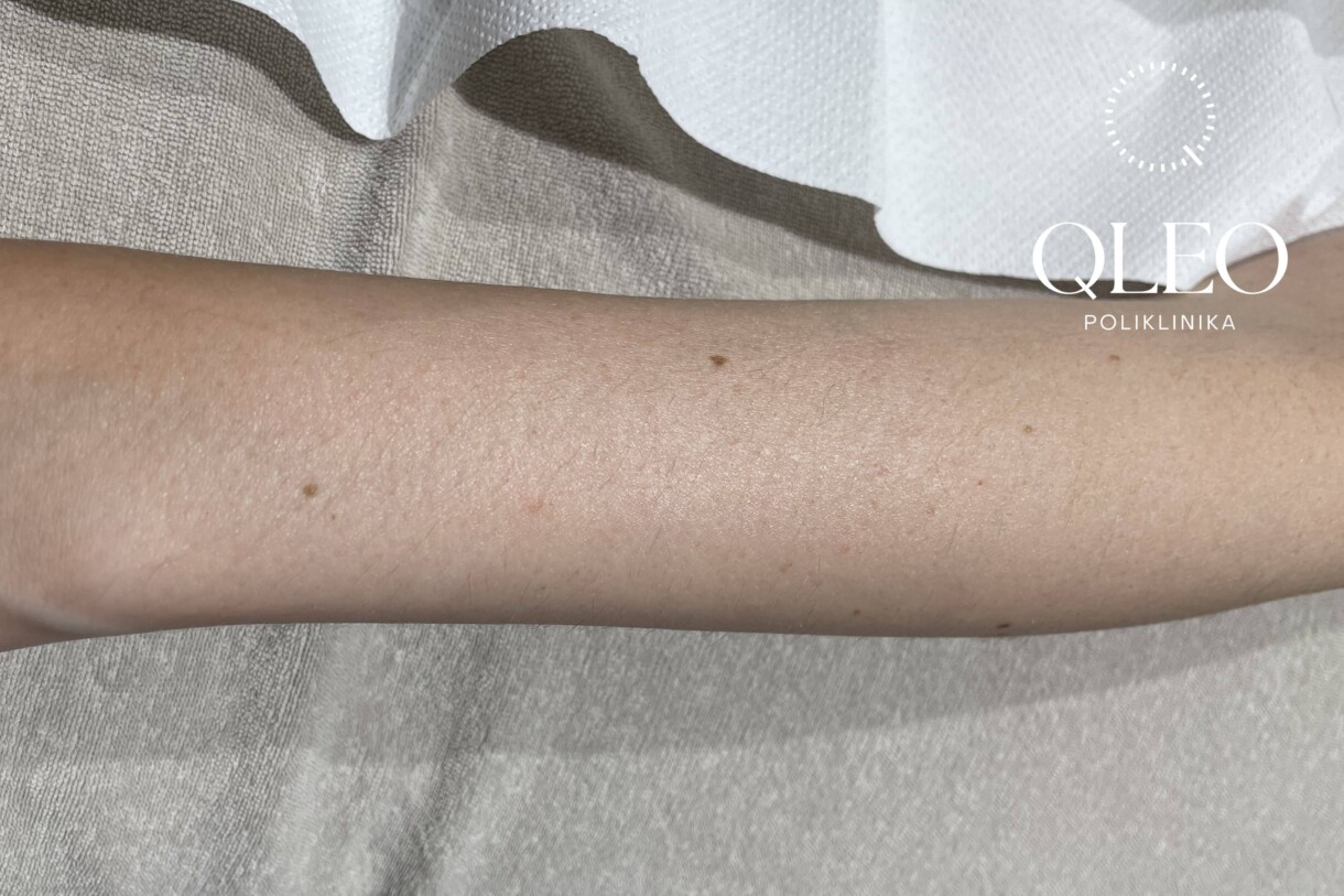 LASERSKA EPILACIJA ŽENE RUKE POSLIJE