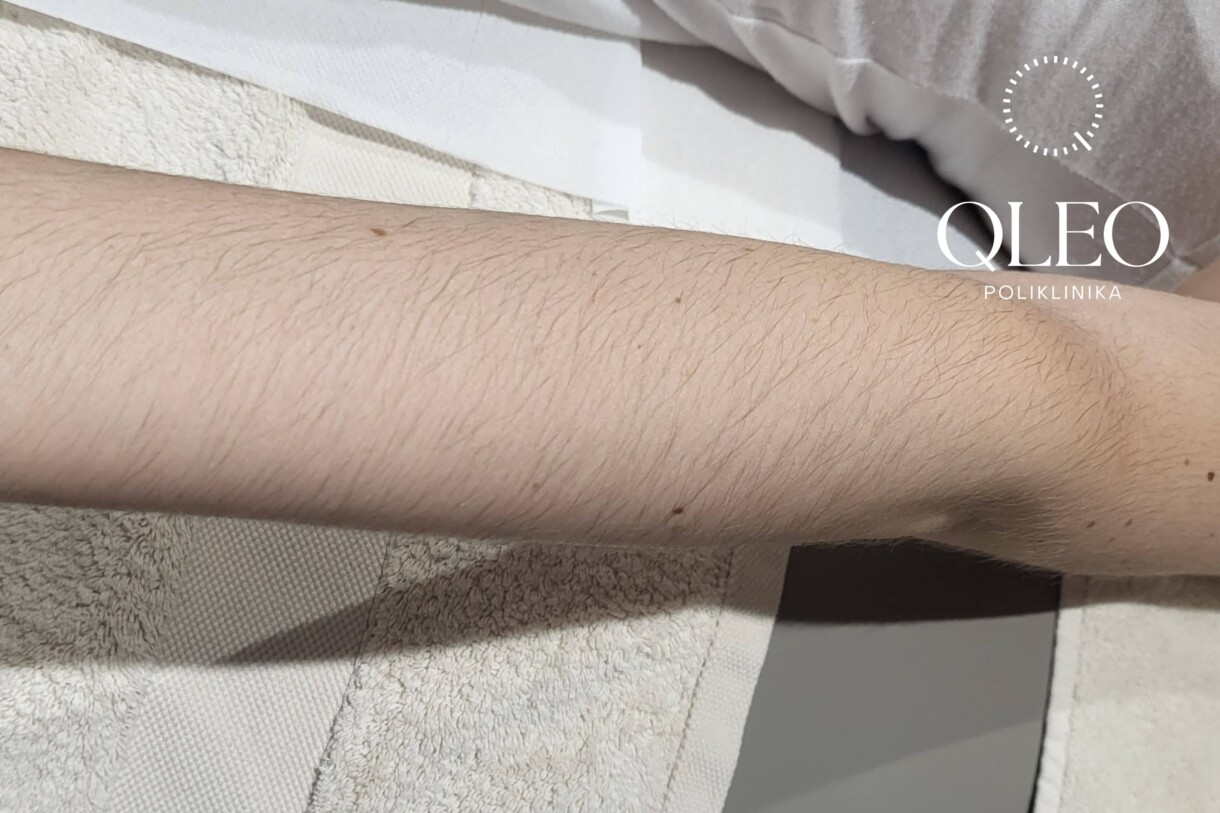 LASERSKA EPILACIJA ŽENE RUKE PRIJE.jpg