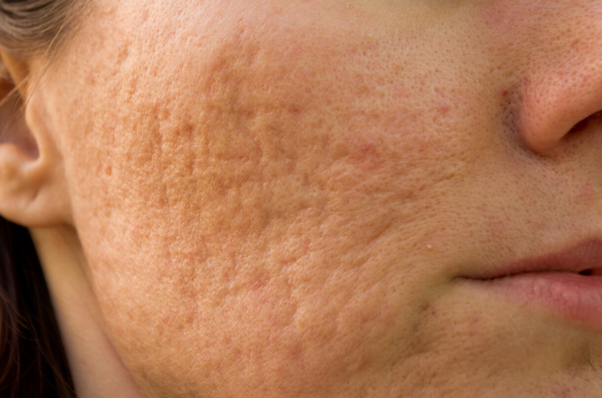 acne scars ožiljci od akni zašto nastaju