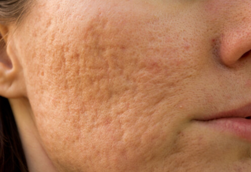 acne scars ožiljci od akni zašto nastaju