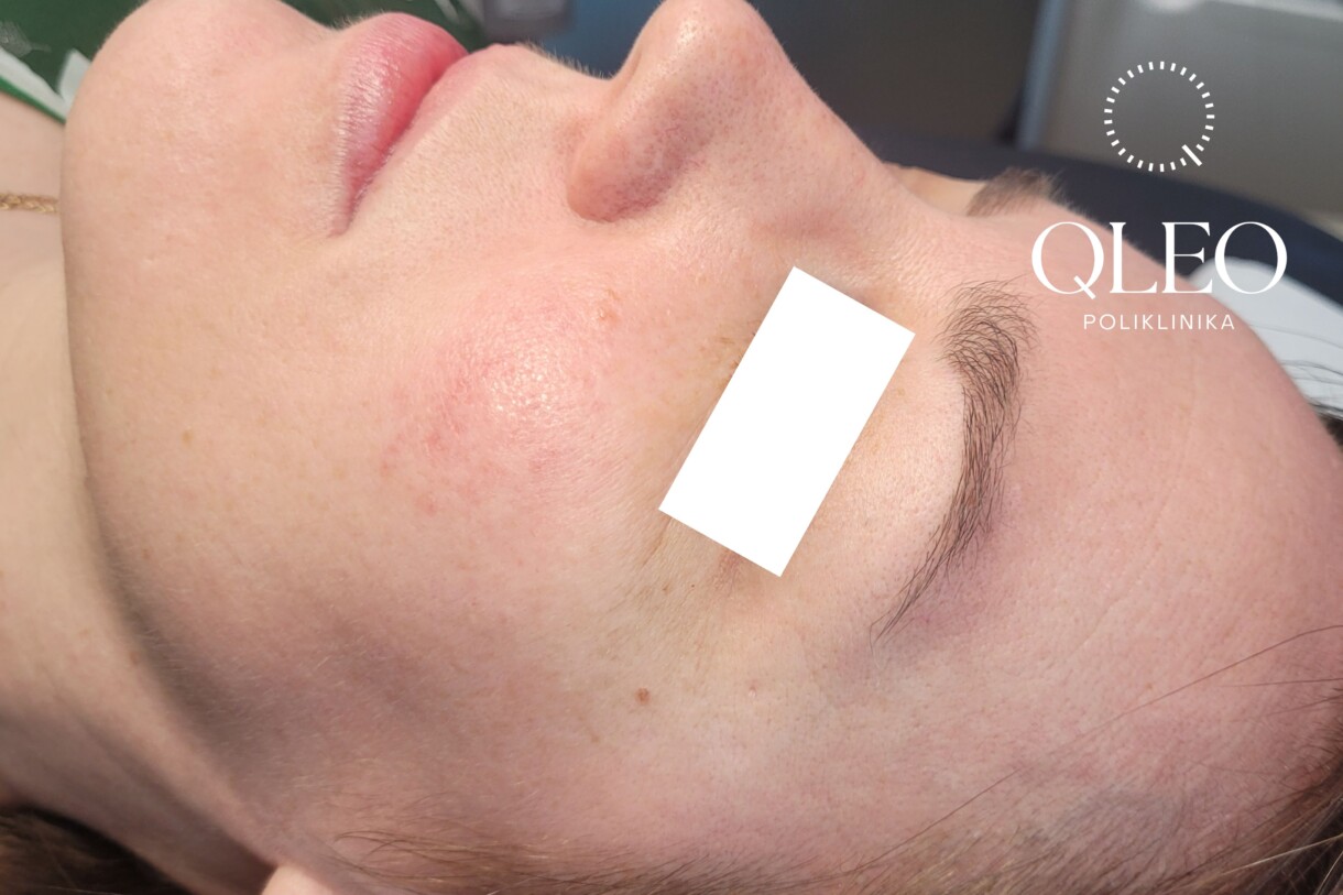 rosacea – poslije