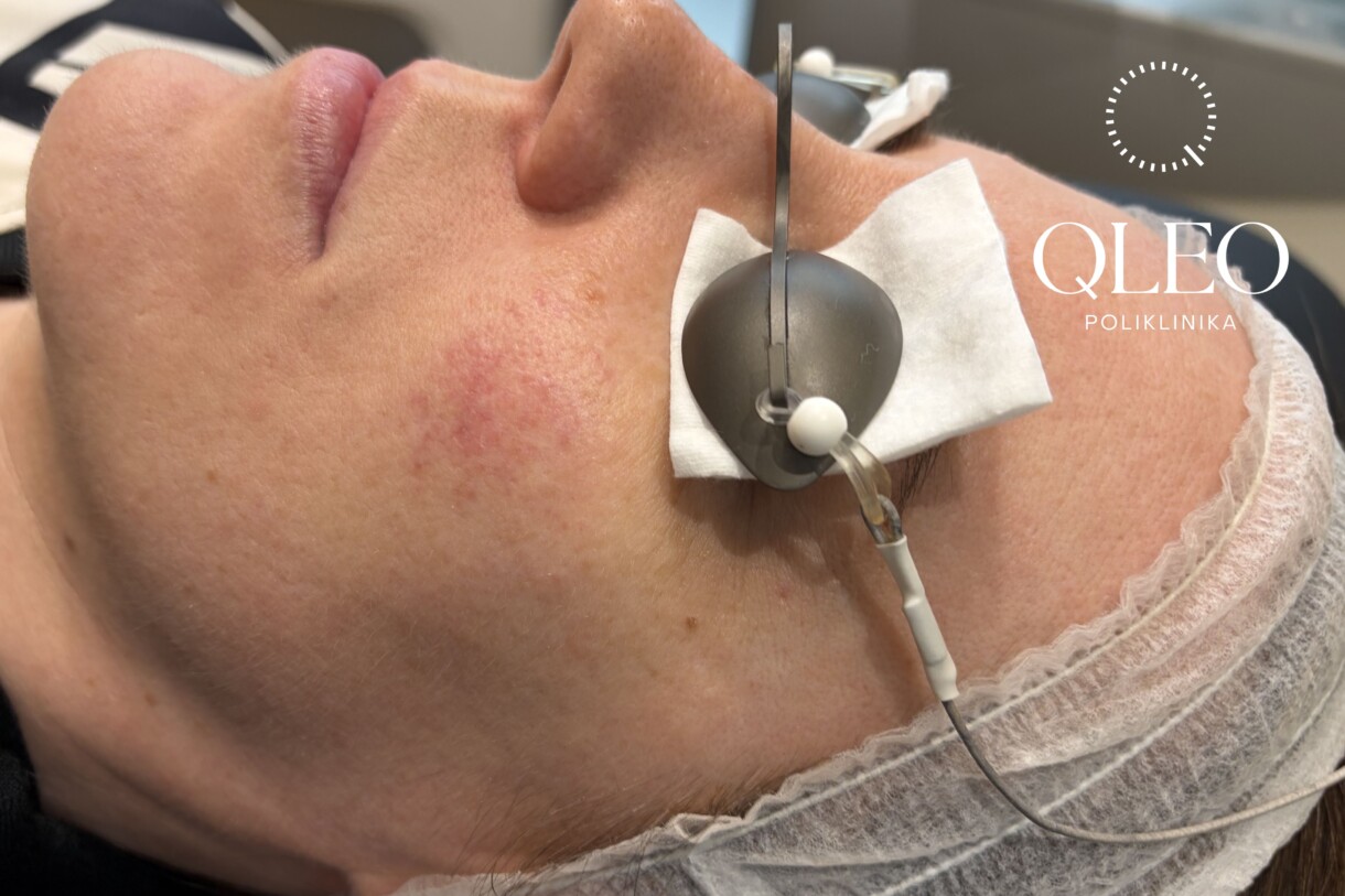 rosacea – prije